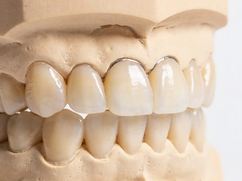 Coroas e ponte cerâmica em modelo